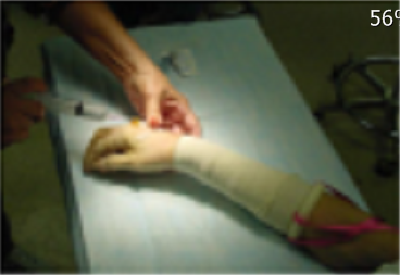 【上肢】腕管综合征：HemaClear的背景资料