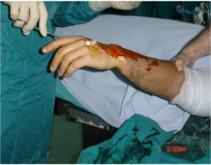 【麻醉】使用前臂无菌弹性驱血止血带辅助进行手及手腕的区域、局部麻醉——回顾