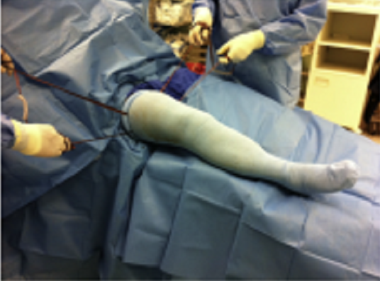 【膝关节】双侧TKA手术输血量的减少和感染率的降低