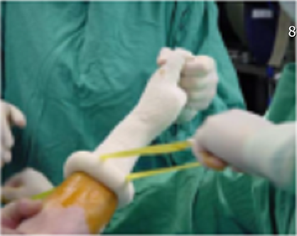 【手部手术】对在手部无血手术中应用新款的止血装置的评价研究