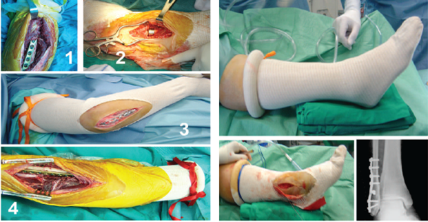 【膝关节】整形外科中硅胶环止血带的使用