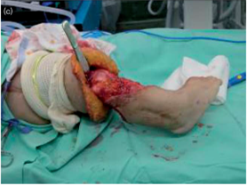 【小儿骨科】在小儿肢体整形外科手术中应用常规充气气囊止血带的替代产品——新颖的橡胶驱血止血带