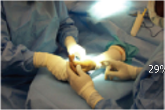 【手部手术】手部外科手术使用S-MART止血带：是提供无血手术区域的一个安全有效方法
